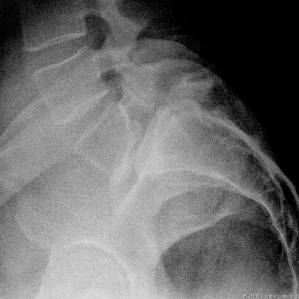 Cirugia columna vertebral Donostia Dr. Alberto Hernandez Especialista de Columna Vertebral